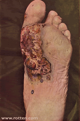 Diseased Feet